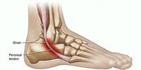 Peroneal Tendonitis